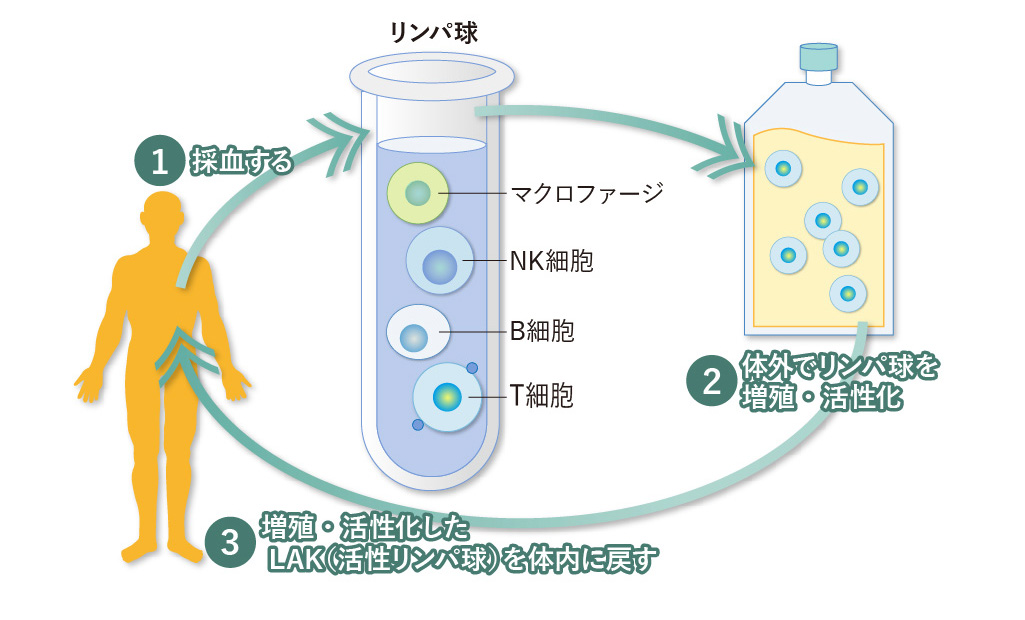 LAK療法（活性化リンパ球療法） のプロセス