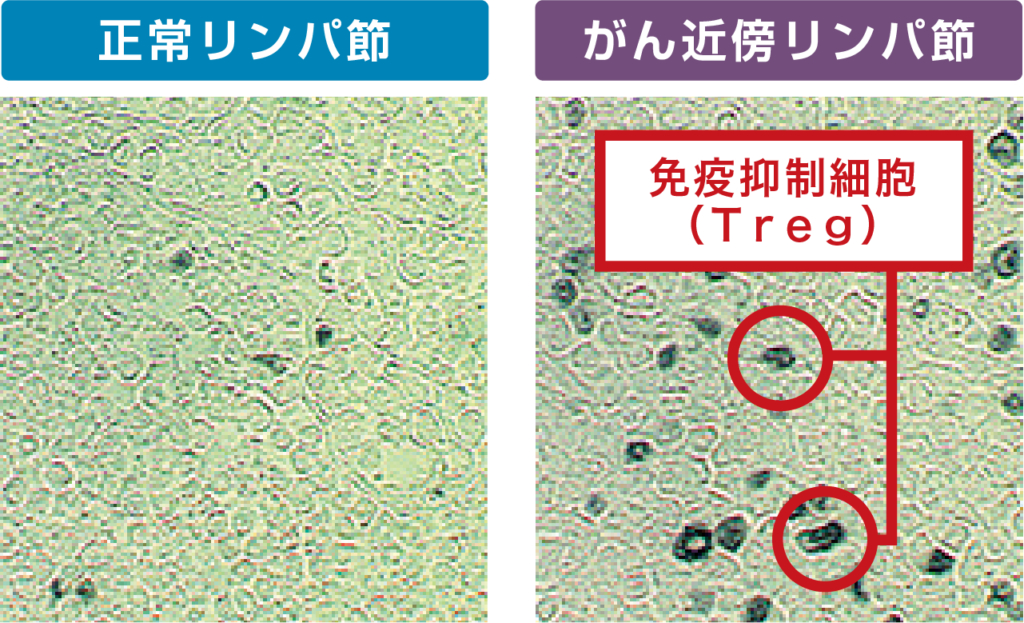 Tregが増えて免疫が低下している状態
左：正常リンパ節
右：がん近傍リンパ節（免疫抑制細胞（Treg））